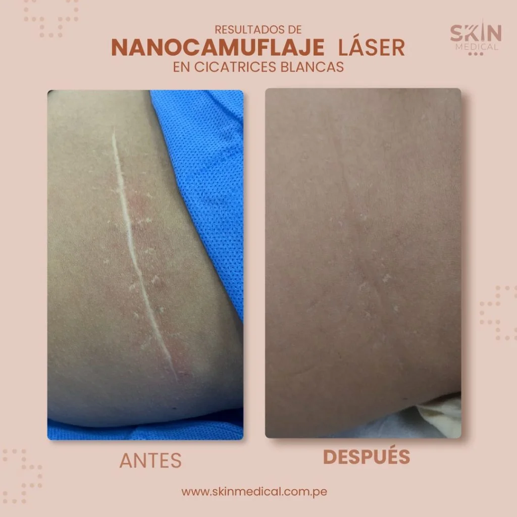 tratamiento de cicatriz nanocamuflaje