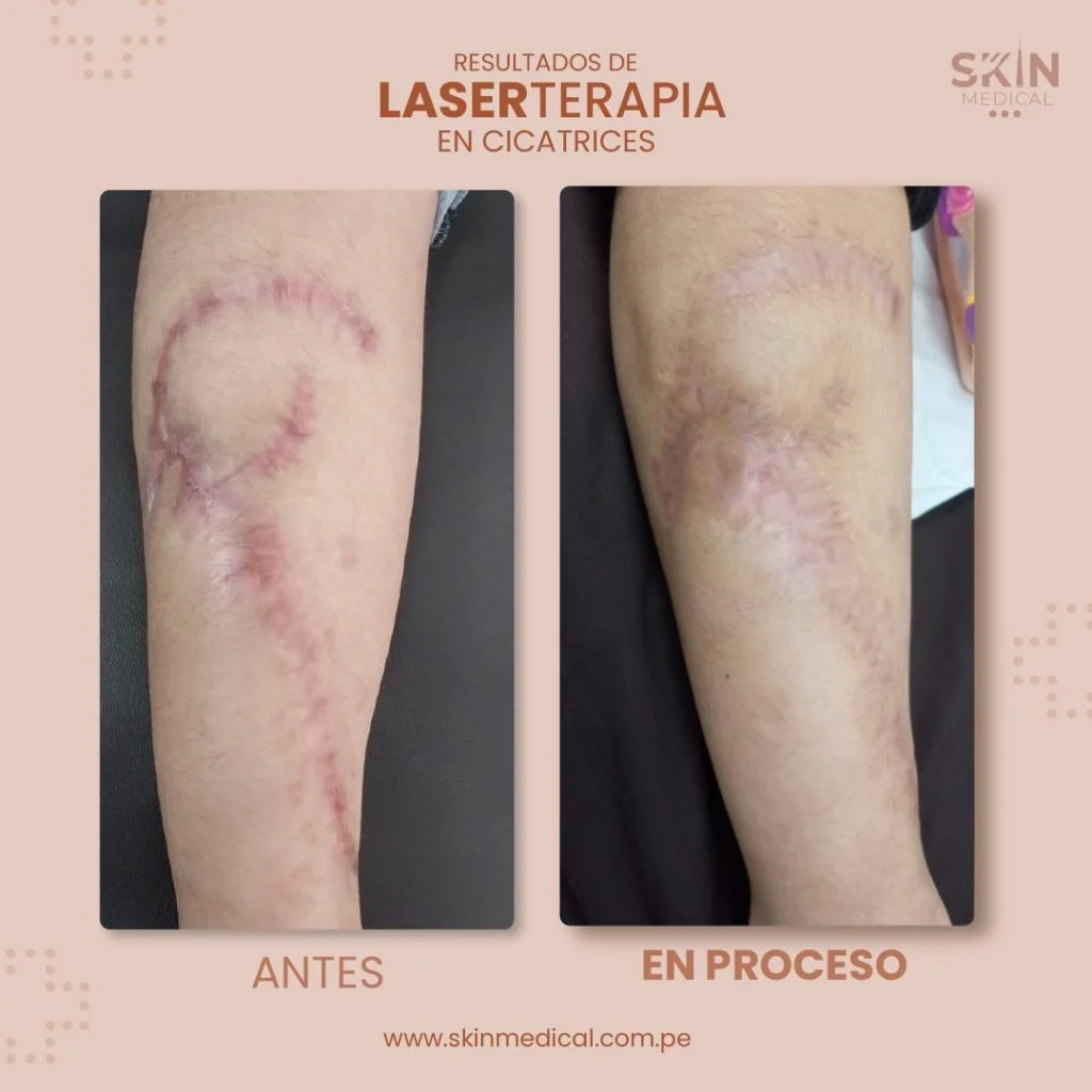 tratamiento de cicatriz laser láser