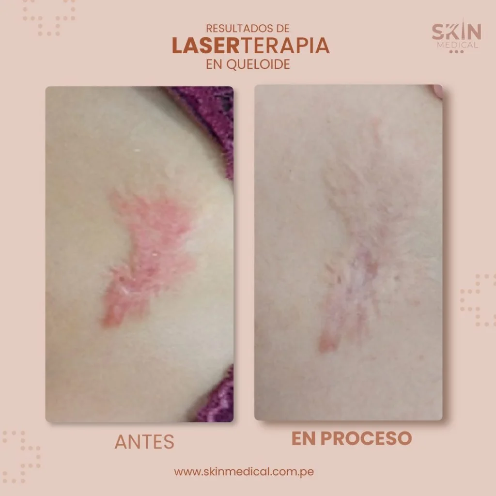 tratamiento de cicatriz laserterapia