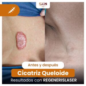 QUELOIDE-ANTES-Y-DESPUES.jpg
